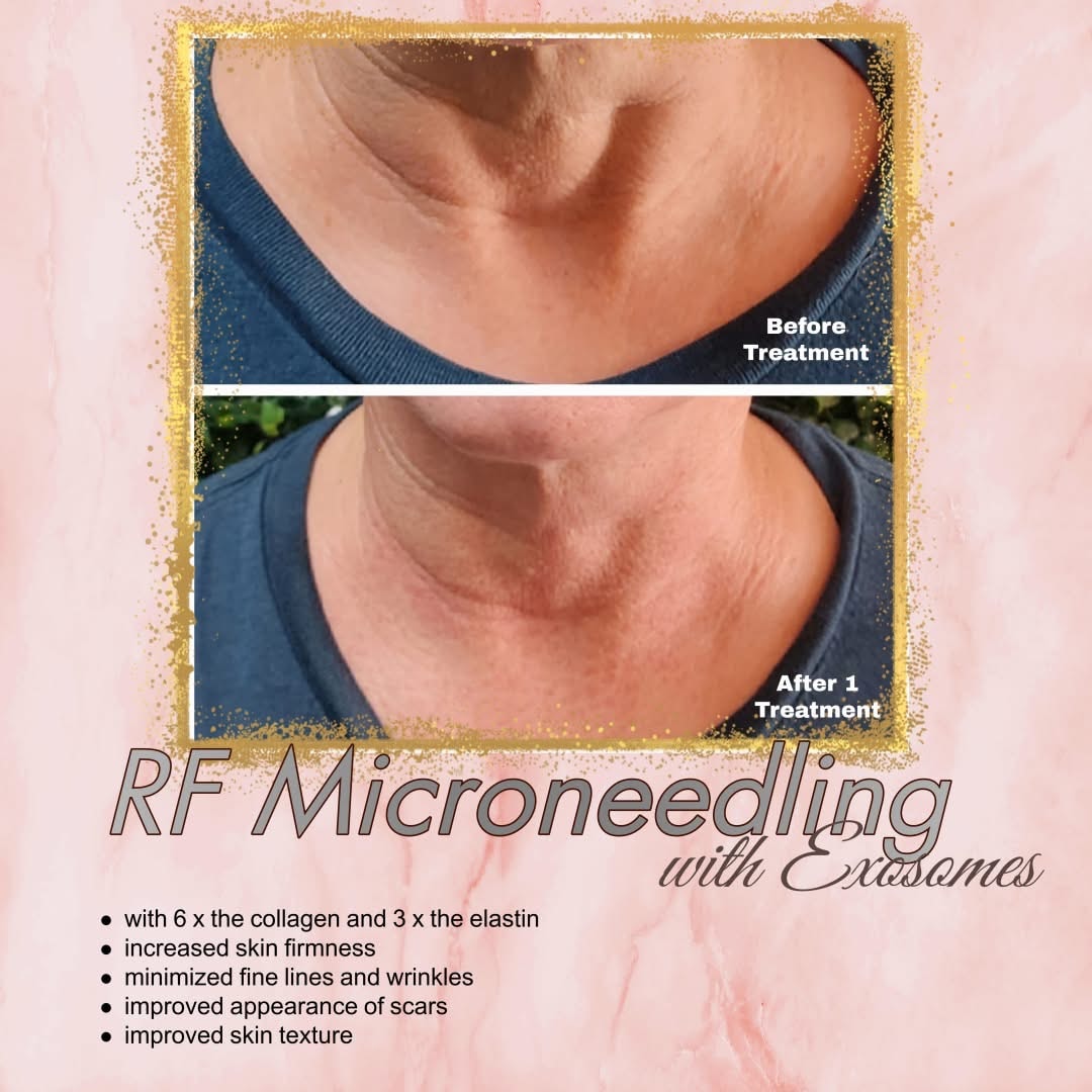 Before and after treatment results at Liberty Med & Spa