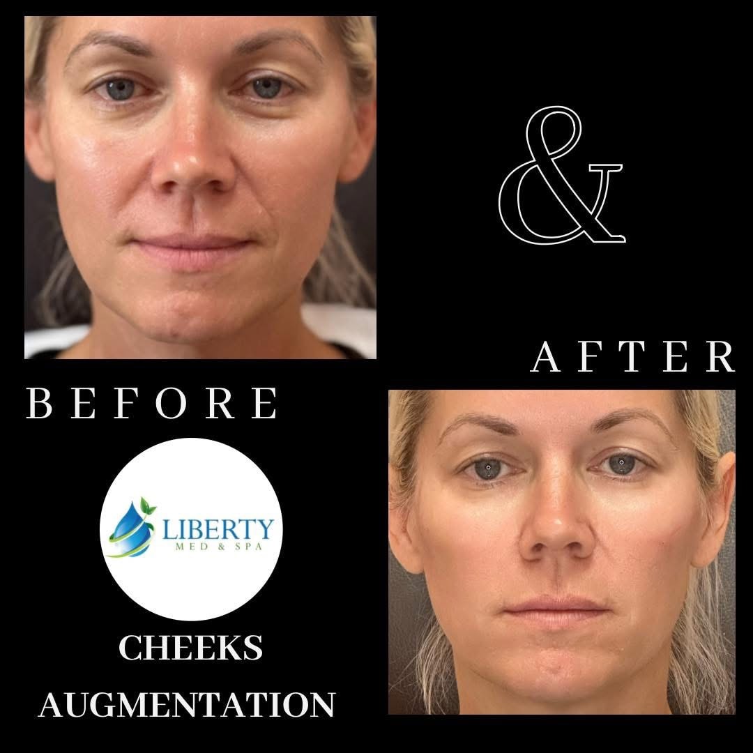 Before and after cheeks augmentation results at Liberty Med & Spa