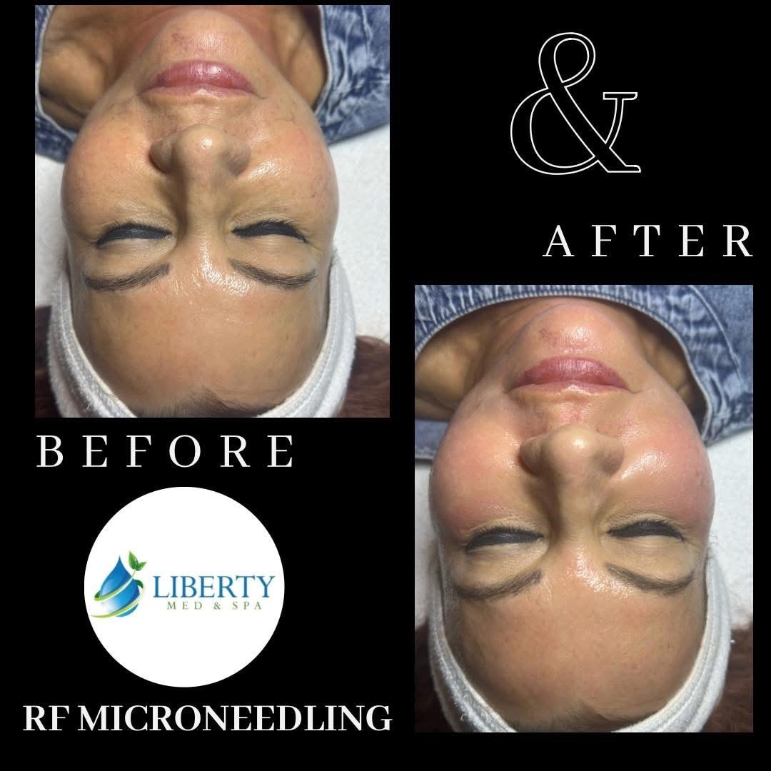 Before and after RF Microneedling facial results at Liberty Med & Spa