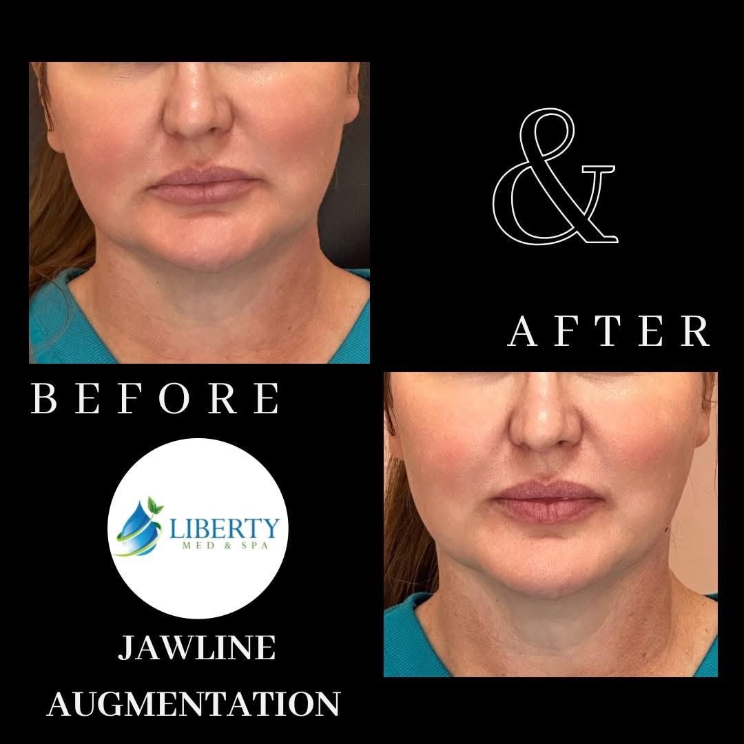Before and after jawline augmentation results at Liberty Med & Spa
