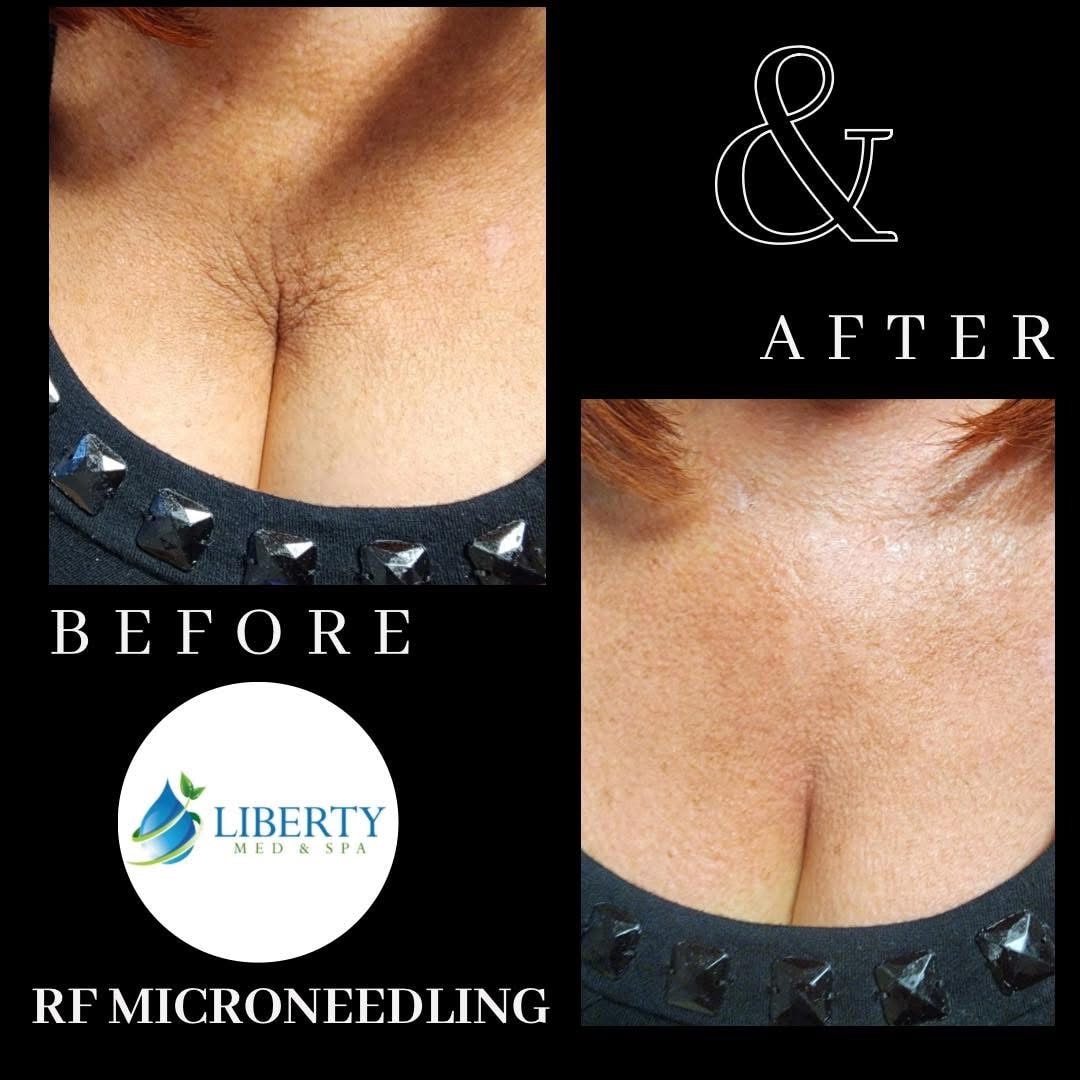 Mesotherapy