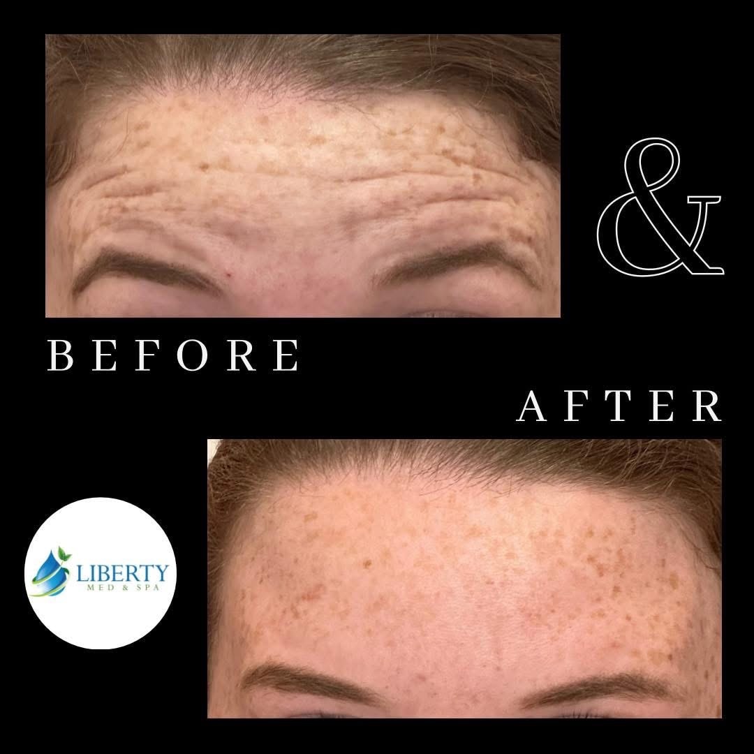 Before and after forehead wrinkle smoothing results at Liberty Med & Spa
