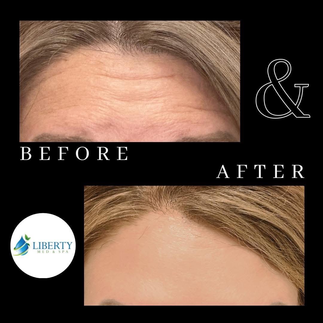 Before and after forehead wrinkle smoothing with neurotoxin at Liberty Med & Spa