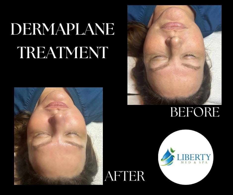 Before and after Dermaplane treatment results at Liberty Med & Spa