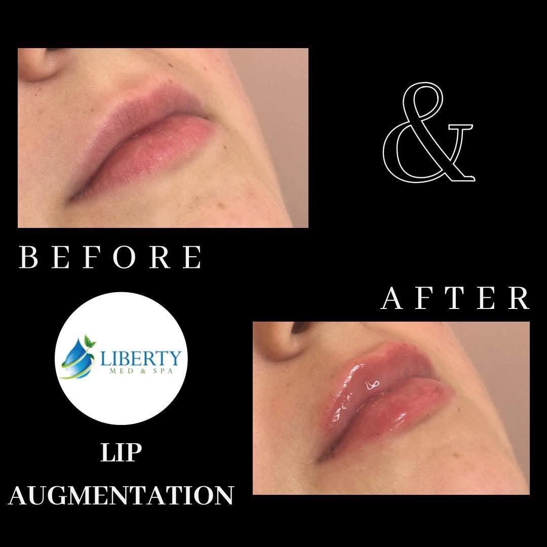 Before and after treatment results at Liberty Med & Spa