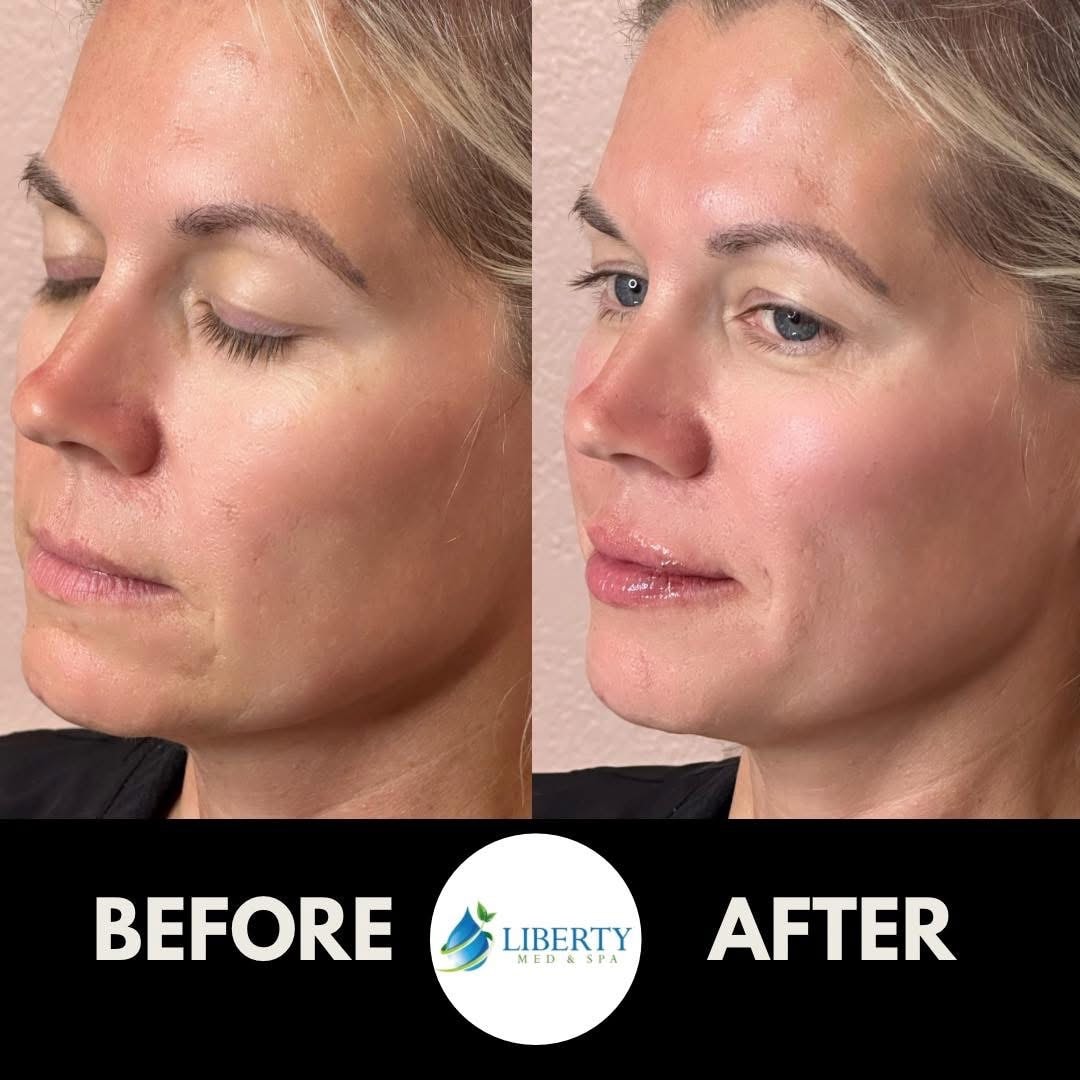 Before and after forehead line treatment results at Liberty Med & Spa