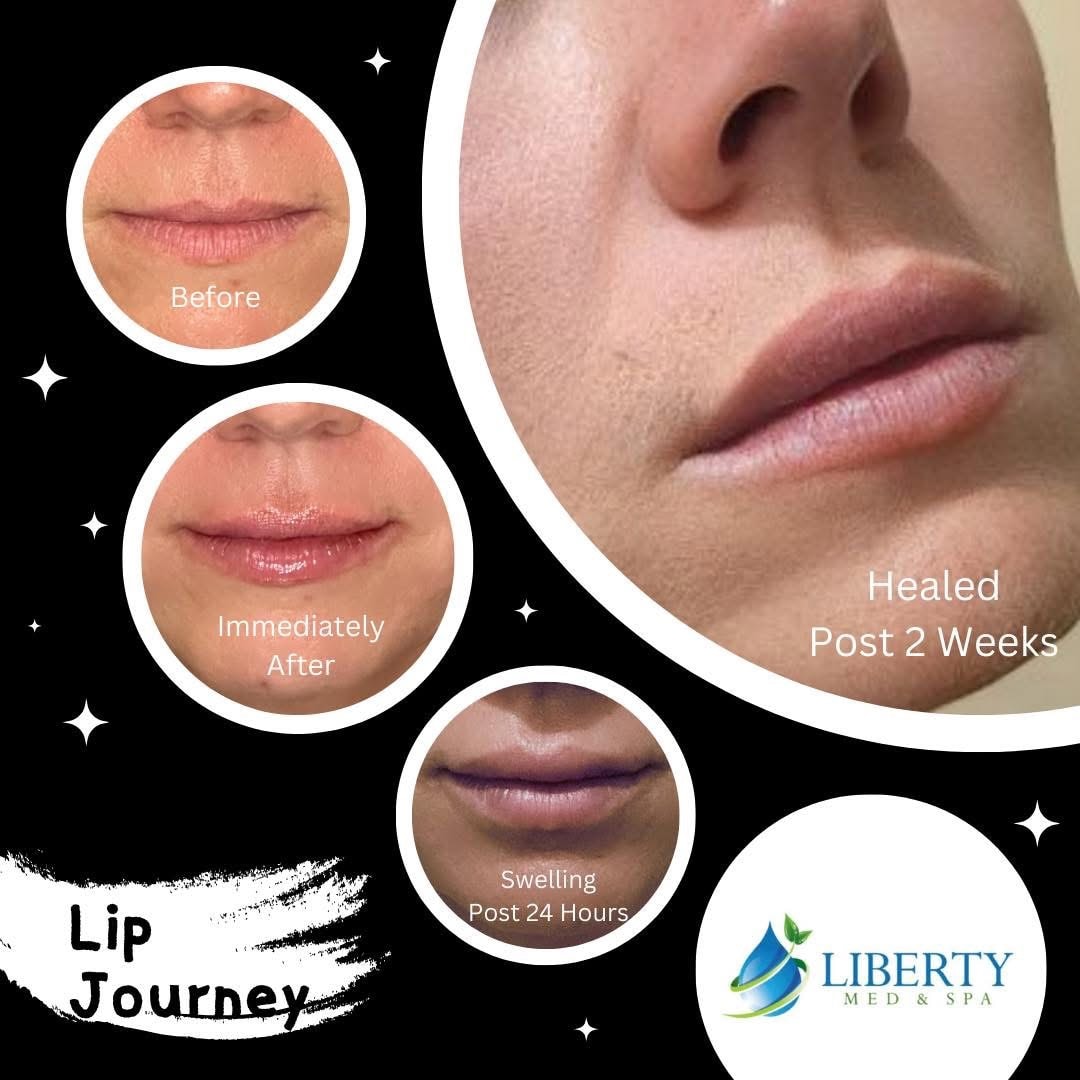 Before and after full face rejuvenation results at Liberty Med & Spa