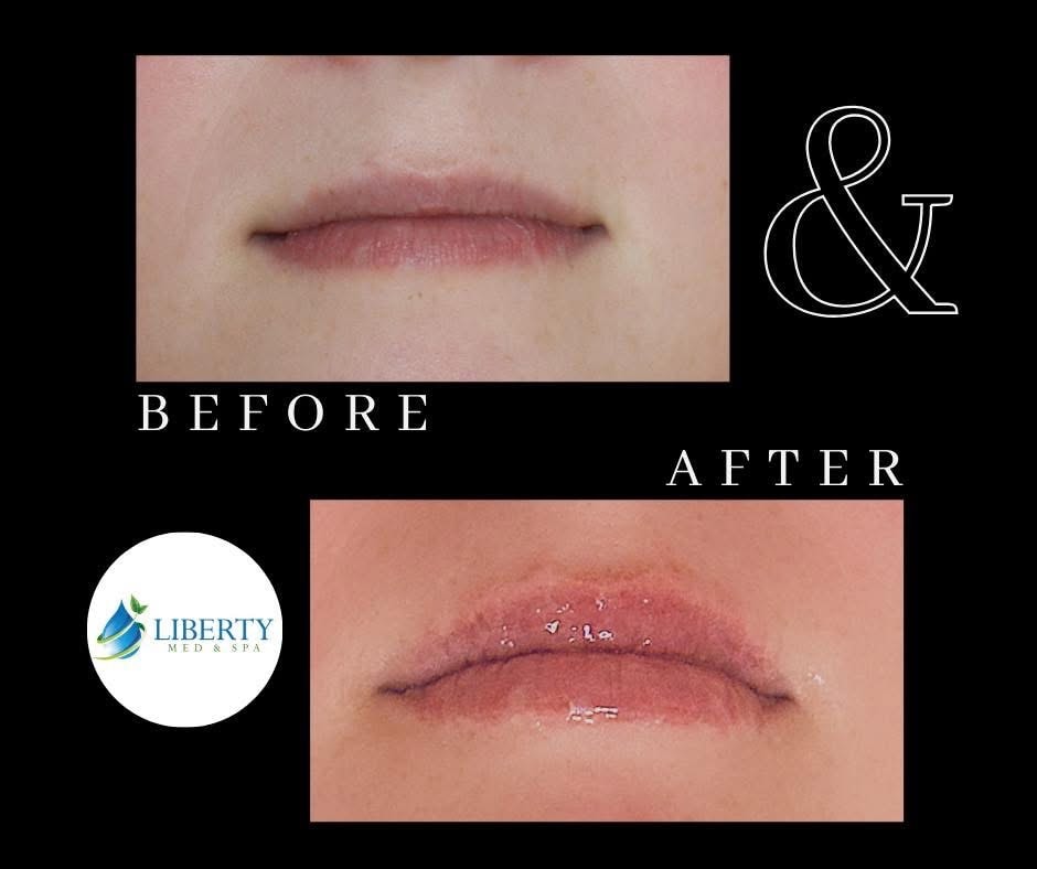 Before and after lip augmentation results at Liberty Med & Spa