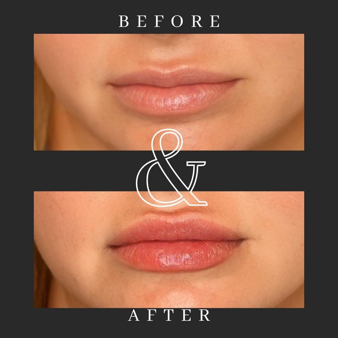 Before and after lip augmentation results at Liberty Med & Spa