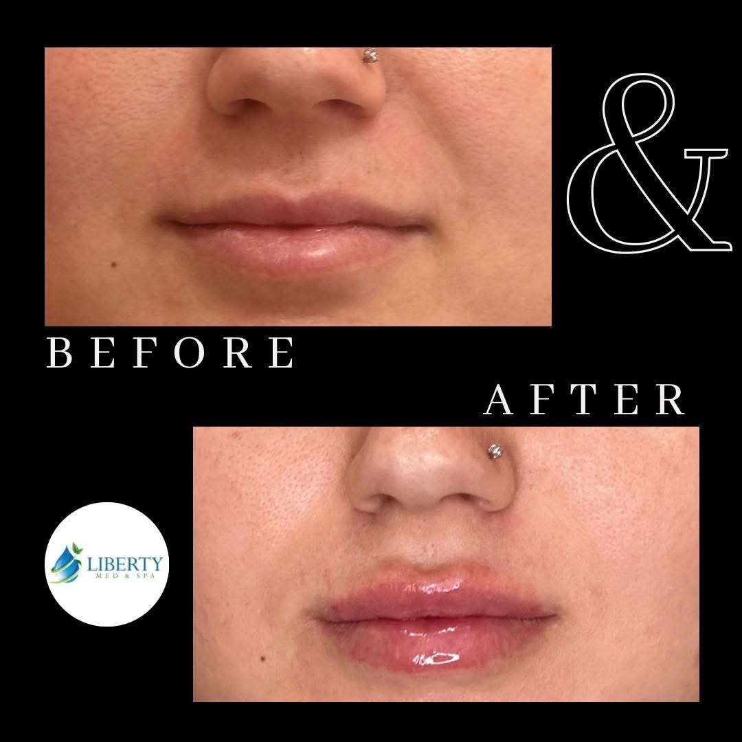 Before and after lip augmentation results at Liberty Med & Spa