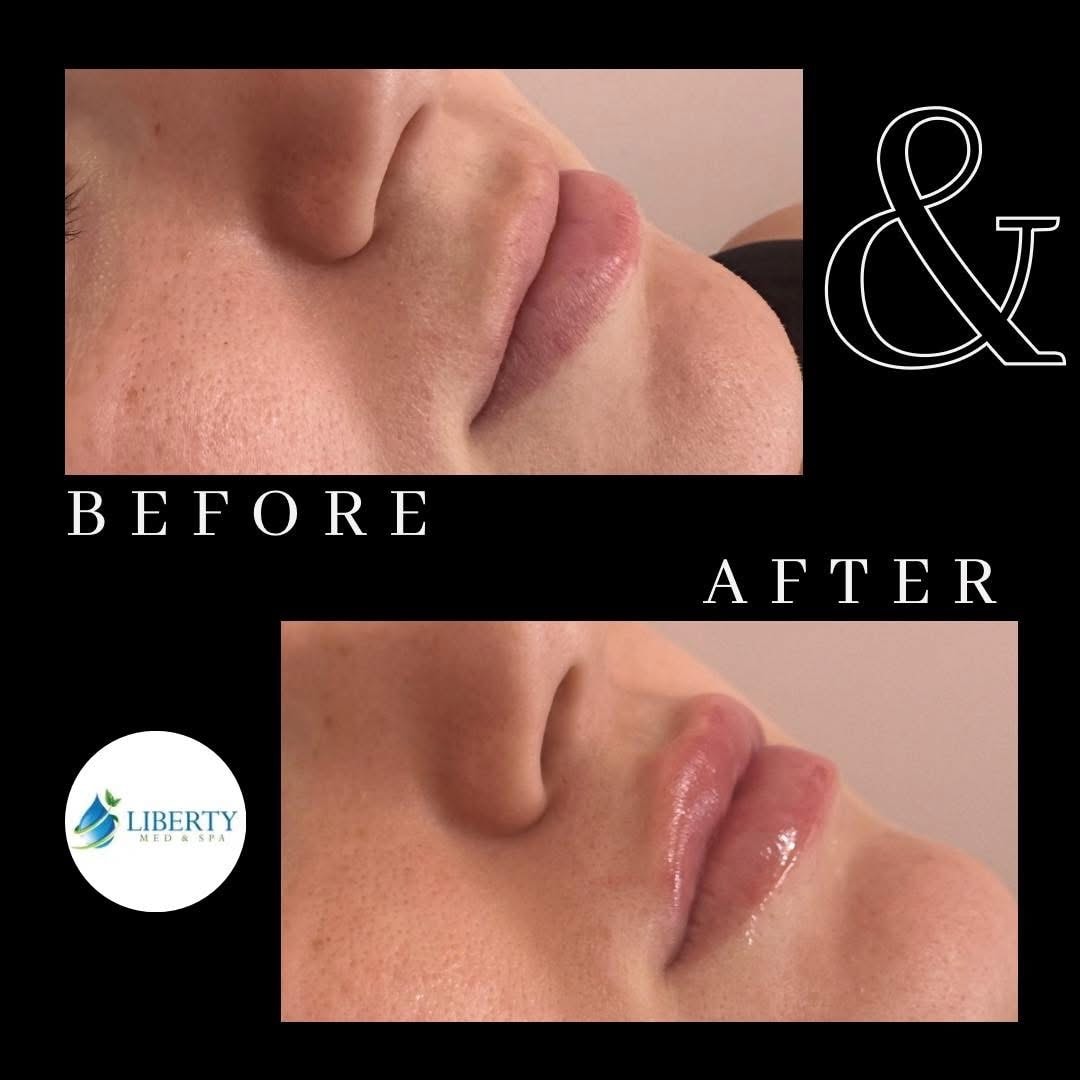Before and after lip augmentation results at Liberty Med & Spa
