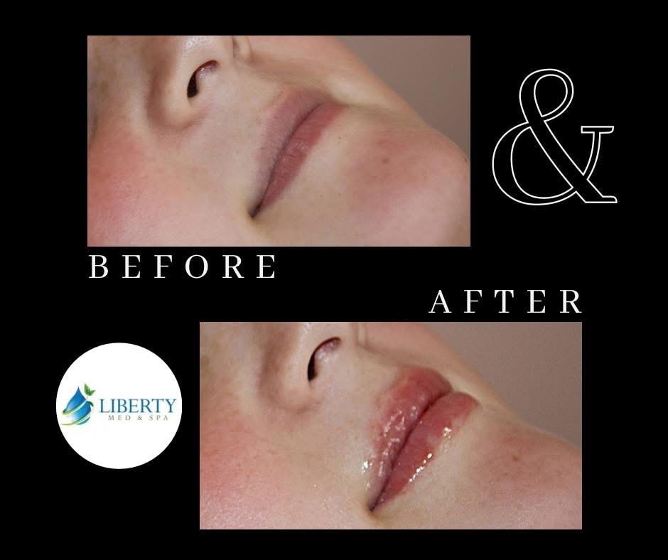 Before and after lip augmentation results at Liberty Med & Spa