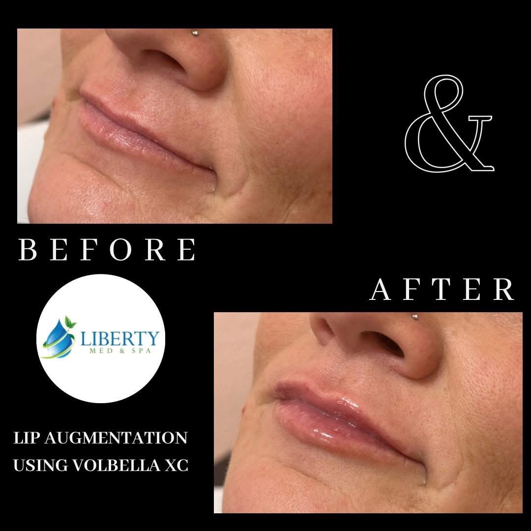Before and after treatment results at Liberty Med & Spa