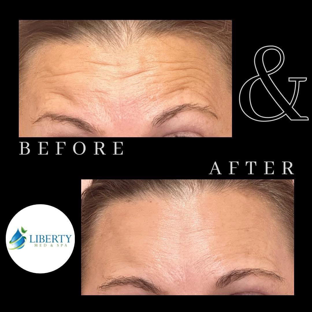 Before and after forehead wrinkle treatment results at Liberty Med & Spa