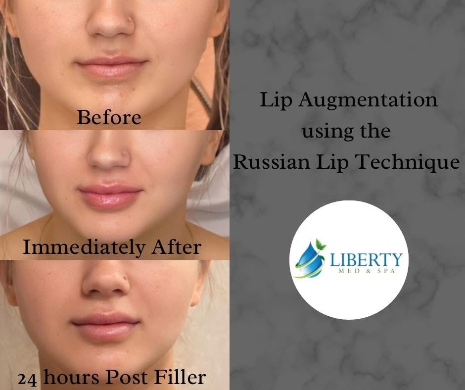 Before, immediately after, and 24 hours post filler — lip augmentation using the Russian Lip Technique at Liberty Med & Spa