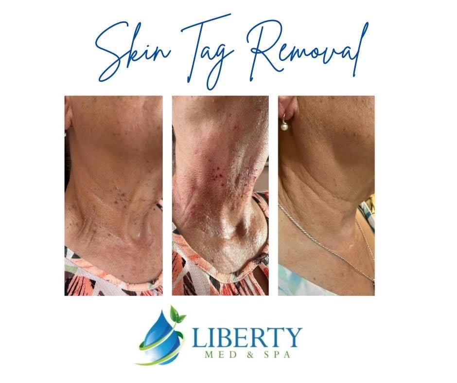 Before and after skin tag removal results at Liberty Med & Spa