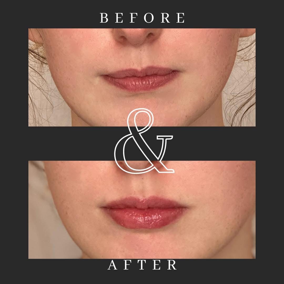 Before and after lip augmentation results at Liberty Med & Spa