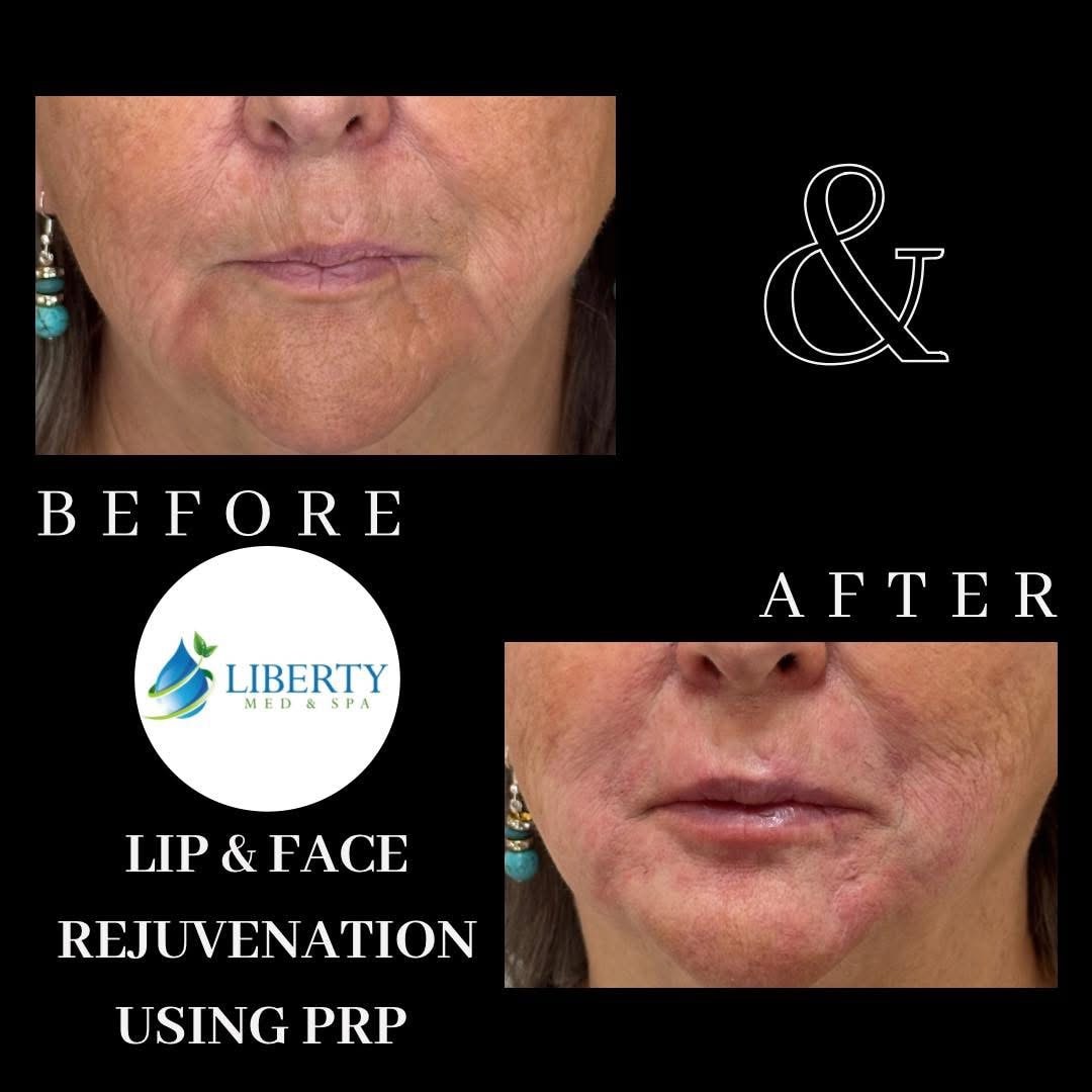 Before and after treatment results at Liberty Med & Spa