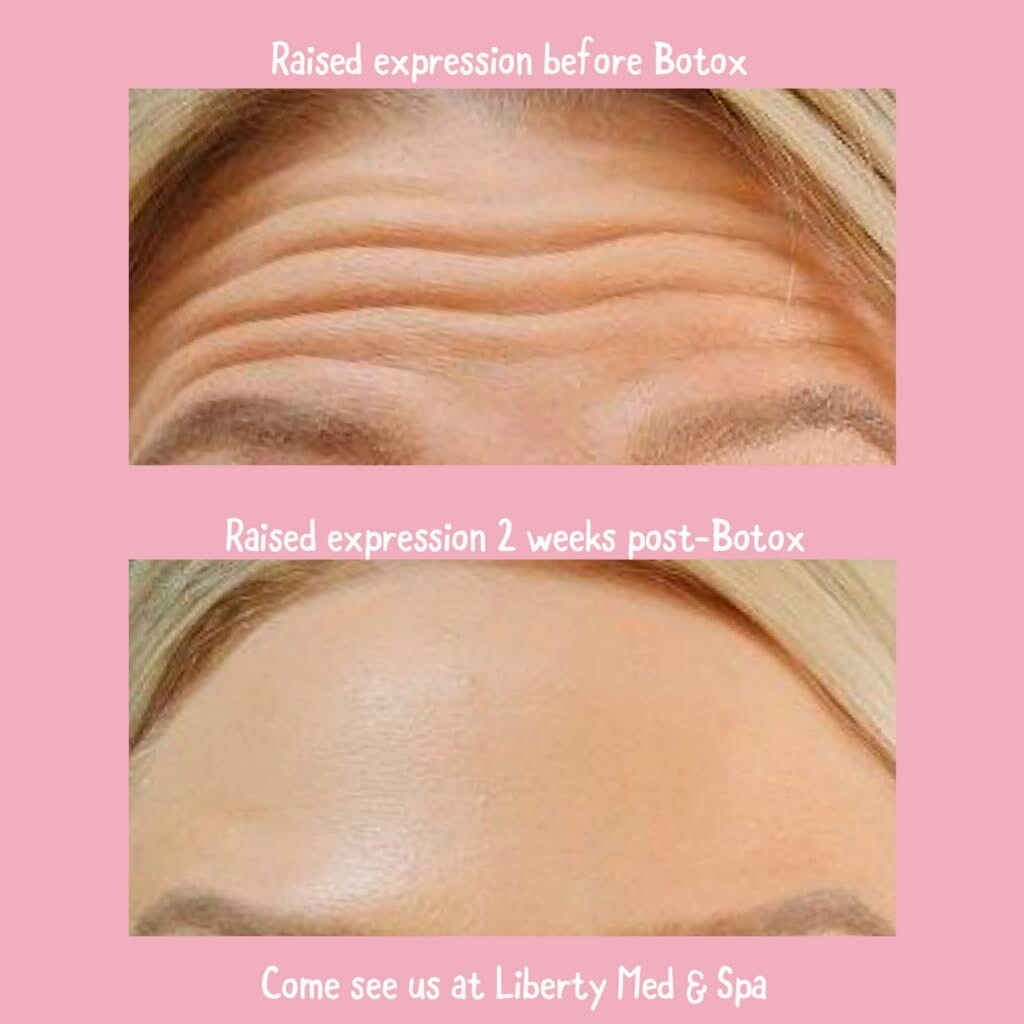 Before and after Botox forehead wrinkle treatment results at Liberty Med & Spa
