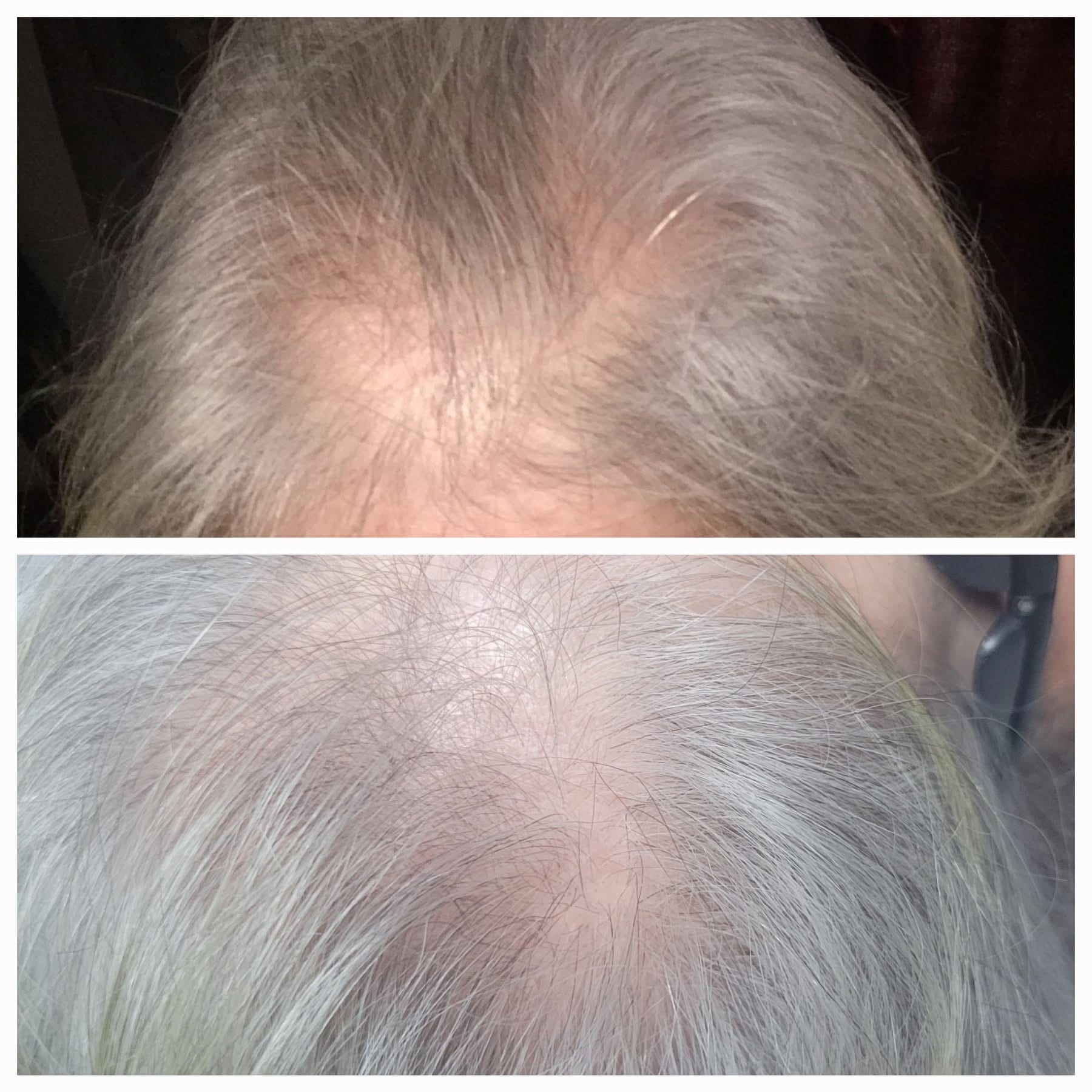 Before and after PRP hair restoration results at Liberty Med & Spa