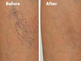 Before and after spider vein and vascular treatment results at Liberty Med & Spa