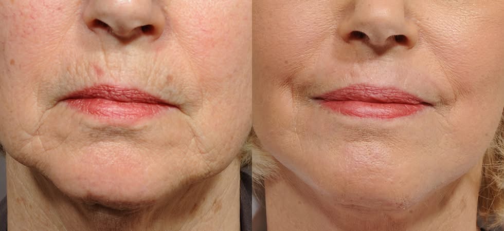 Before and after perioral lines and lip area rejuvenation results at Liberty Med & Spa