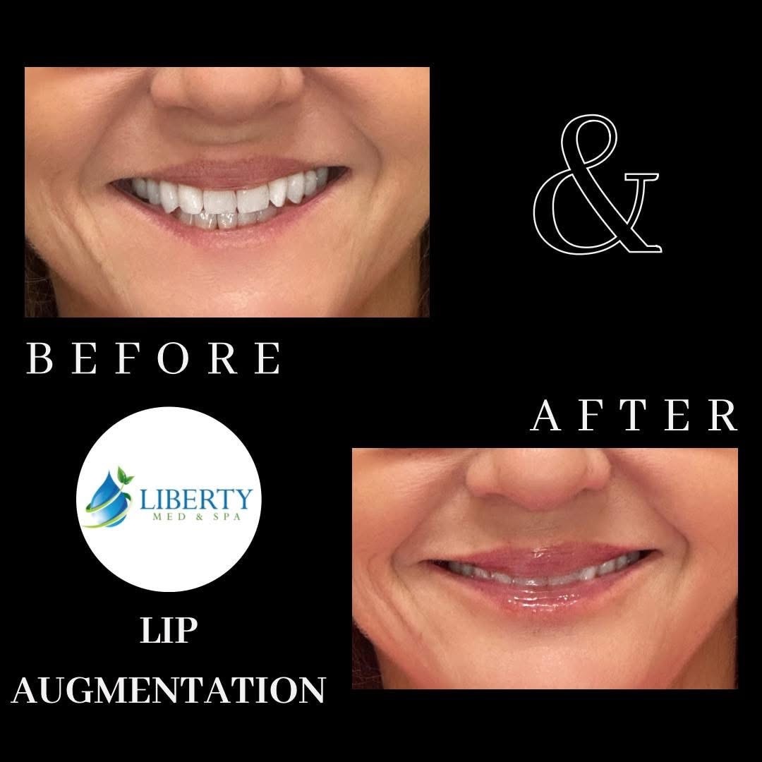 Before and after treatment results at Liberty Med & Spa