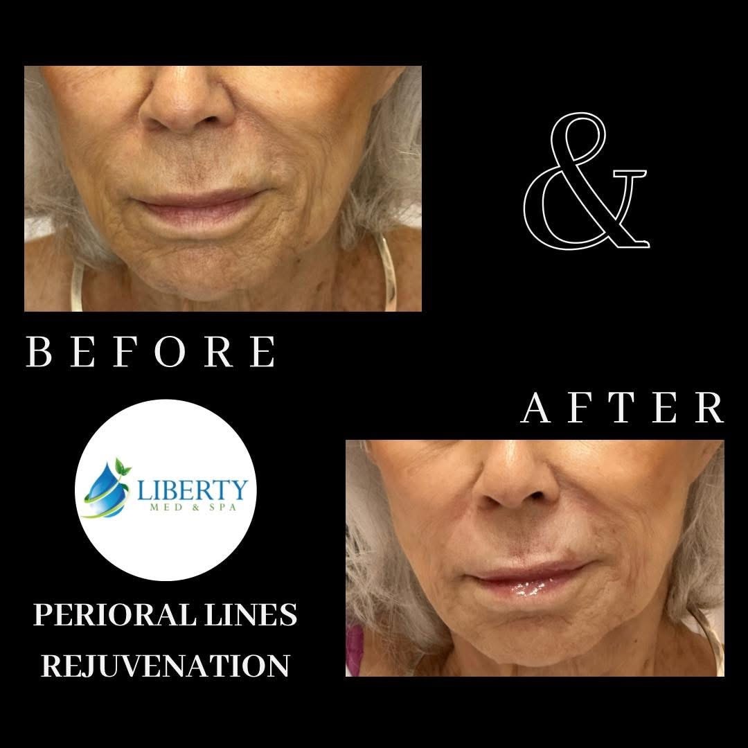 Before and after treatment results at Liberty Med & Spa