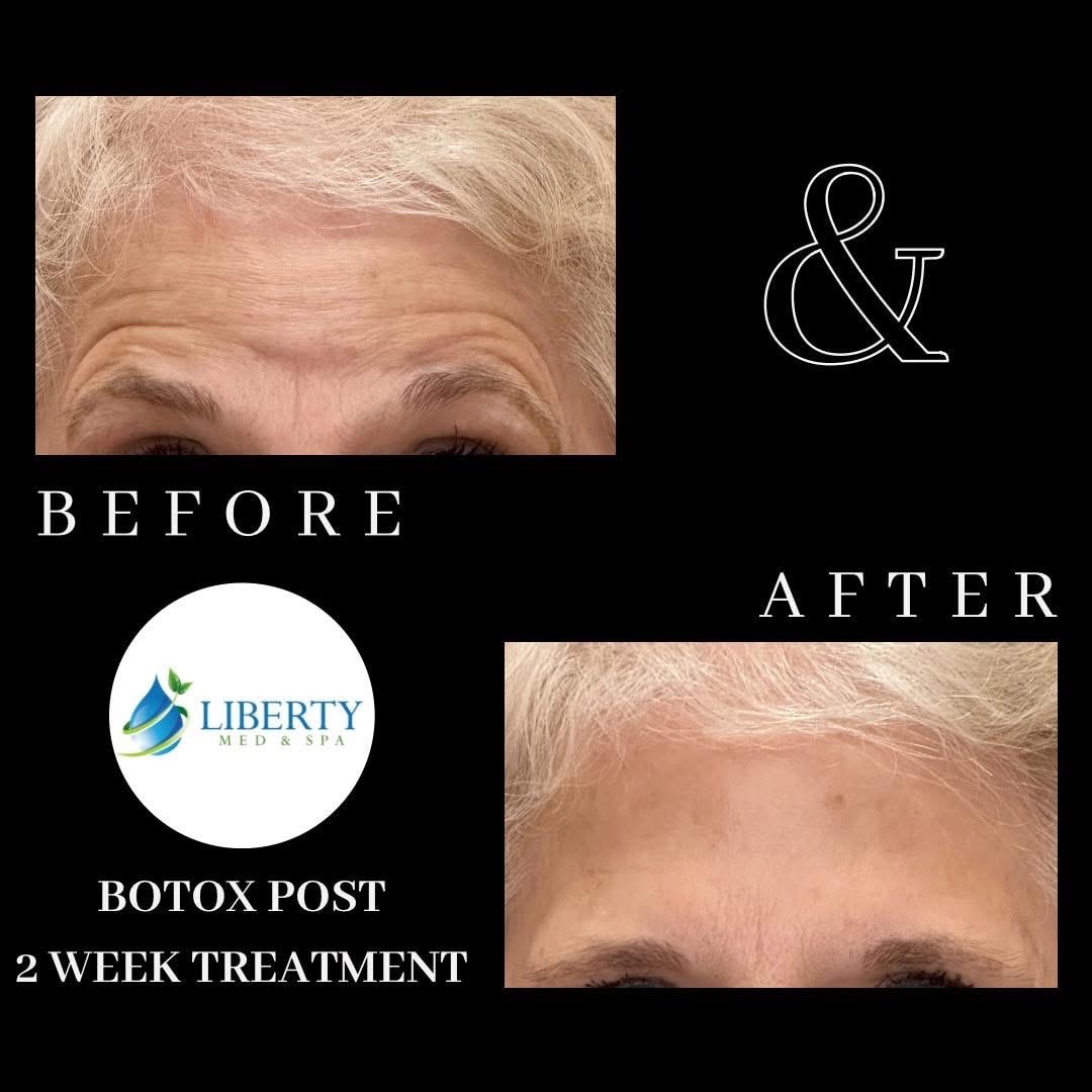 Before and after treatment results at Liberty Med & Spa